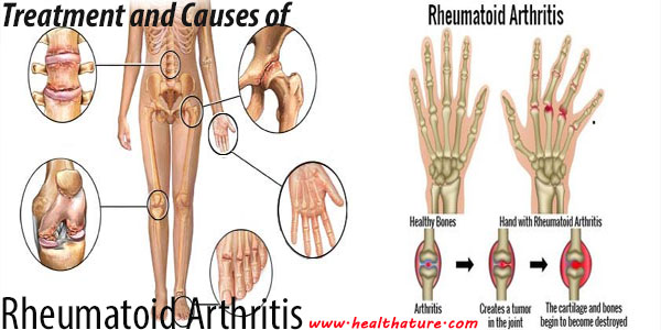 Rheumatoid Arthristis Treatment