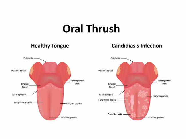 Oral Thrush Symptoms